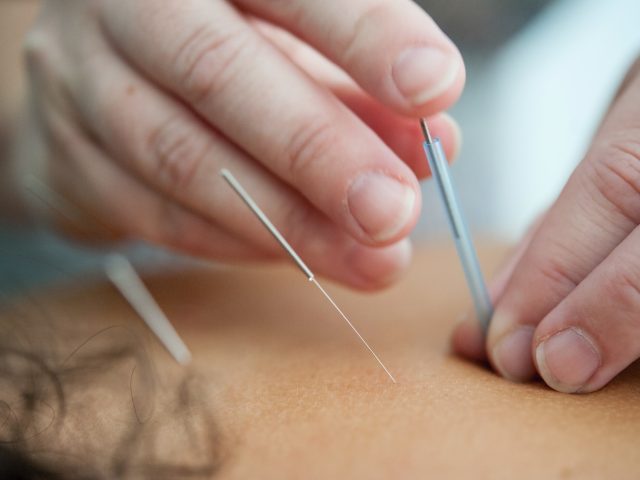 acupuncture